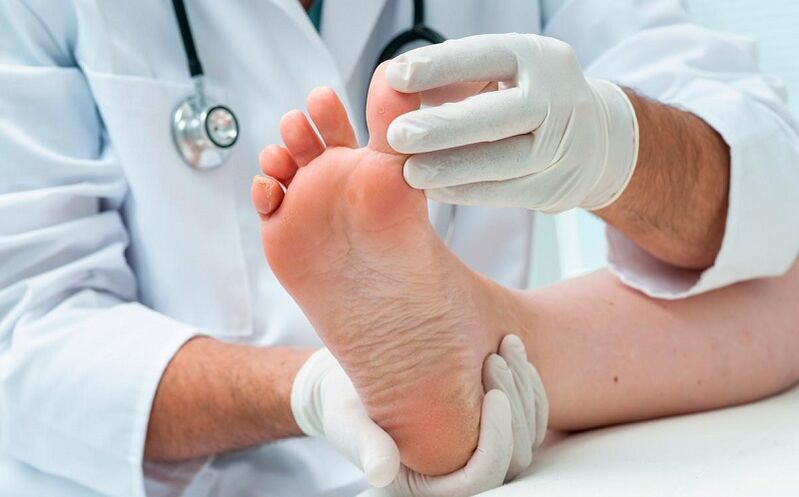 as well as how to treat foot fungus