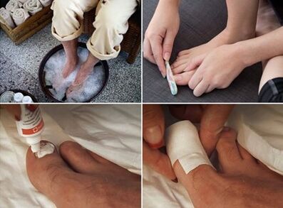 Steam the feet and apply urea cream on the nails affected by the fungus