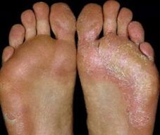 Feet with mycosis