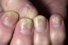change in nail with fungal infection
