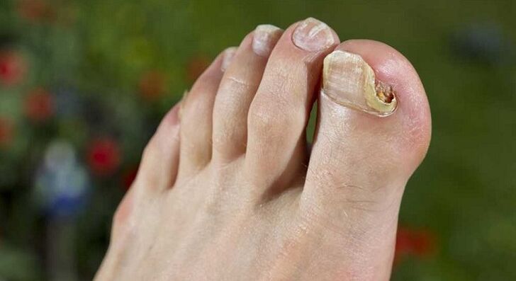 damage to the nail plate with fungus on the feet