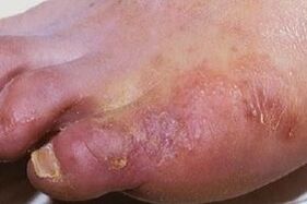 manifestations of a fungal infection on the skin of the feet