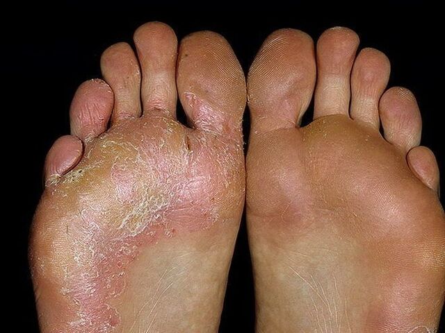 symptoms of a foot fungus