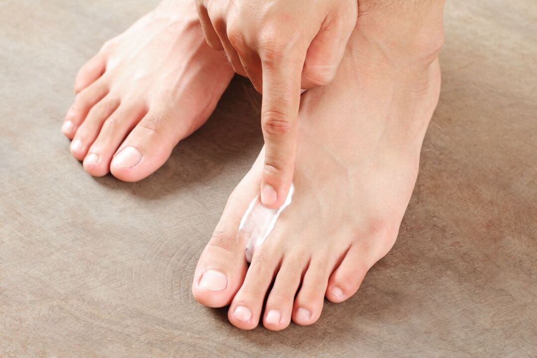 treatment of foot mold with ointment