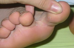 Fungus between the toes
