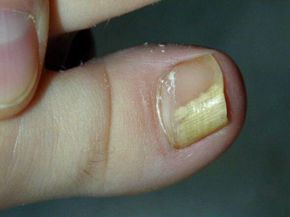 fungal infection of toenails