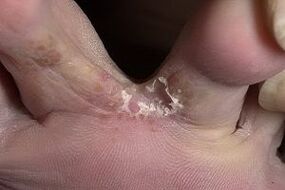 fungus of the skin between the fingers