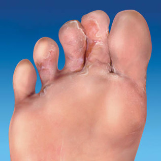 skin fungus on feet