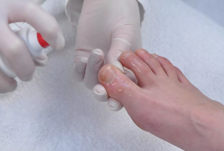 Execution of treatment of nail fungus