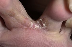 forms of foot fungus