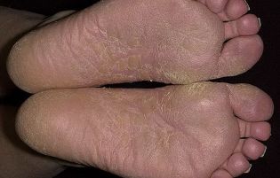 fungus of the feet
