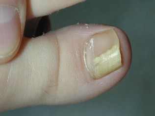 fungus in the big toe